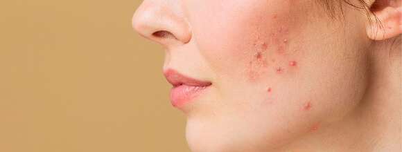 acne