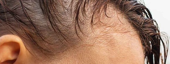 alopecias